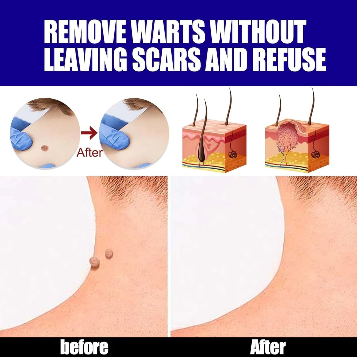 Warts Remover Ointment مرهم إزالة الثآليل